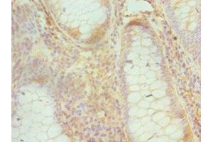 Immunohistochemistry of paraffin-embedded human colon cancer using ABIN7148748 at dilution of 1:100 (Cullin 1 抗体  (AA 500-776))