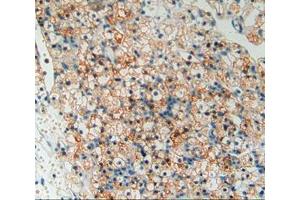 Used in DAB staining on fromalin fixed paraffin- embedded kidney cancer tissue (TOR1AIP2 抗体  (AA 249-476))