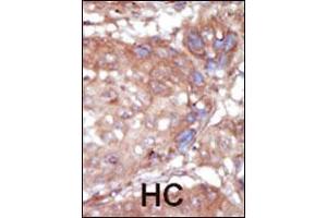 Formalin-fixed and paraffin-embedded human cancer tissue reacted with the primary antibody, which was peroxidase-conjugated to the secondary antibody, followed by AEC staining. (TNK2 抗体  (C-Term))