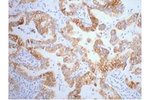 Immunohistochemistry (IHC) staining of Human Lung Cancer tissue, diluted at 1:200.