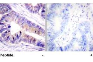 Immunohistochemical analysis of paraffin-embedded human colon carcinoma tissue using YWHAZ polyclonal antibody . (14-3-3 zeta 抗体)