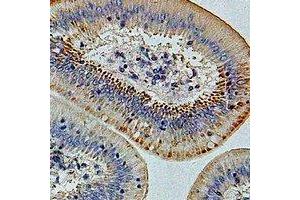 Immunohistochemical analysis of IFI44 staining in human colon cancer formalin fixed paraffin embedded tissue section. (IFI44 抗体)