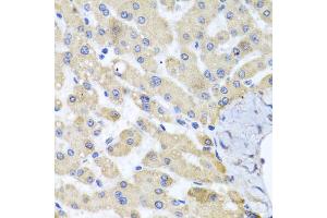 Immunohistochemistry of paraffin-embedded human liver injury using ABCB8 antibody (ABIN5974712) at dilution of 1/100 (40x lens). (ABCB8 抗体)