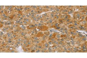 Immunohistochemistry of paraffin-embedded Human liver cancer using TP53I11 Polyclonal Antibody at dilution of 1:40 (TP53I11 抗体)