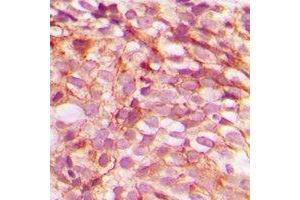 Immunohistochemical analysis of B-RAF (pS446) staining in human breast cancer formalin fixed paraffin embedded tissue section. (SNRPE 抗体  (pSer446))