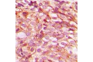 Immunohistochemical analysis of B-RAF (pS446) staining in human breast cancer formalin fixed paraffin embedded tissue section.