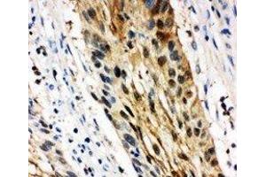 Anti-14-3-3 sigma antibody, IHC(P) IHC(P): Human Oesophagus Squama Cancer Tissue (14-3-3 sigma/SFN 抗体  (Middle Region))