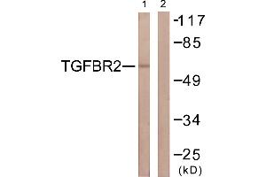 Immunohistochemistry analysis of paraffin-embedded human breast carcinoma tissue using CDC16/APC6 (Ab-560) antibody. (CDC16 抗体  (Ser560))