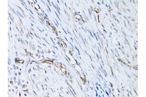 Immunohistochemistry of paraffin-embedded human uterine cancer using SELE Antibody. (Selectin E/CD62e 抗体)
