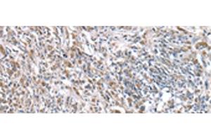 Immunohistochemistry of paraffin-embedded Human prost ate cancer tissue using RNF115 Polyclonal Antibody at dilution of 1:45(x200) (RNF115 抗体)