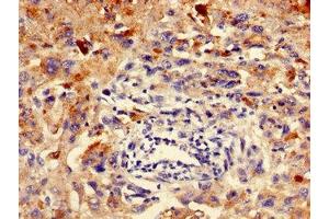 Immunohistochemistry of paraffin-embedded human melanoma using ABIN7151778 at dilution of 1:100 (ELMO3 抗体  (AA 464-596))