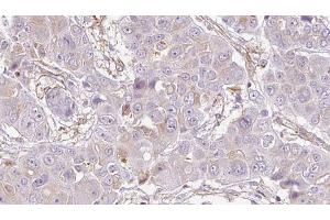 ABIN6272736 at 1/100 staining Human liver cancer tissue by IHC-P. (P2RY10 抗体  (Internal Region))
