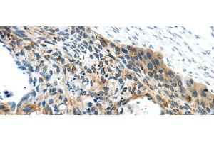 Immunohistochemistry of paraffin-embedded Human esophagus cancer using VAMP2 Polyclonal Antibody at dilution of 1/40 (VAMP2 抗体)