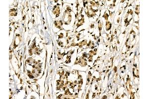 ABIN6256421 and ABIN6267295 at 1/100 staining Human pancreatic cancer and adjacent nomal tissues by IHC-P. (HSP27 抗体  (pSer78))