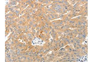 The image on the left is immunohistochemistry of paraffin-embedded Human ovarian cancer tissue using (TEP1 Antibody) at dilution 1/50, on the right is treated with synthetic peptide. (TEP1 抗体)