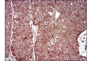 Immunohistochemical analysis of paraffin-embedded ovarian cancer tissues using MMEL1 mouse mAb with DAB staining. (MMEL1 抗体  (AA 1-107))