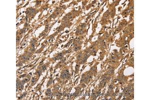 Immunohistochemistry of Human esophagus cancer using CAPZA3 Polyclonal Antibody at dilution of 1:40