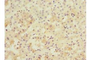 Immunohistochemistry of paraffin-embedded human liver cancer using ABIN7165942 at dilution of 1:100 (PPM1D 抗体  (AA 1-250))
