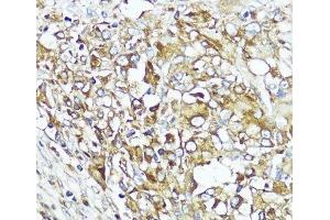 Immunohistochemistry of paraffin-embedded Human liver cancer using MLKL Polyclonal Antibody at dilution of 1:200 (40x lens). (MLKL 抗体)