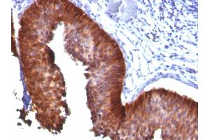 Formalin-fixed, paraffin-embedded human Bladder Carcinoma stained with CK17 Mouse Monoclonal Antibody (E3). (KRT17 抗体)