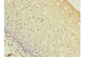 Immunohistochemistry of paraffin-embedded human cervical cancer using ABIN7142427 at dilution of 1:100 (MRPL48 抗体  (AA 29-212))