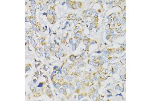 Immunohistochemistry of paraffin-embedded human breast cancer using J antibody (ABIN1678787, ABIN3018048, ABIN3018049 and ABIN6220343) at dilution of 1:100 (40x lens). (ATP5J 抗体  (AA 1-108))