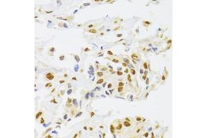 Immunohistochemistry of paraffin-embedded human breast cancer using hnRNP  Antibody (ABIN6128029, ABIN6141896, ABIN6141899 and ABIN6223388) at dilution of 1:100 (40x lens). (HNRNPA1 抗体  (AA 1-372))