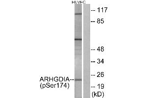 Immunohistochemistry analysis of paraffin-embedded human cervix carcinoma tissue using ARHGDIA (Phospho-Ser174) antibody. (ARHGDIA 抗体  (pSer174))