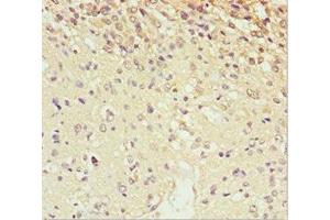 Immunohistochemistry of paraffin-embedded human glioma using ABIN7168663 at dilution of 1:100 (SCRN2 抗体  (AA 176-425))