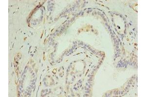 Immunohistochemistry of paraffin-embedded human breast cancer using ABIN7150021 at dilution of 1:100 (DIP2A 抗体  (AA 1-300))