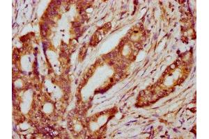 IHC image of ABIN7169246 diluted at 1:600 and staining in paraffin-embedded human colon cancer performed on a Leica BondTM system. (PPP2R2B 抗体  (Regulatory Subunit B))