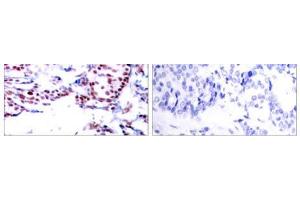Immunohistochemical analysis of paraffin- embedded human breast carcinoma tissue using ATF-2 (Ab-71or 53) antibody (E021031). (ATF2 抗体)