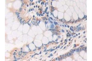 Detection of AKAP11 in Human Colorectal cancer Tissue using Polyclonal Antibody to A Kinase Anchor Protein 11 (AKAP11)