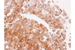 IHC-P Image Immunohistochemical analysis of paraffin-embedded PLC xenograft, using NQO2, antibody at 1:100 dilution. (NQO2 抗体  (Center))