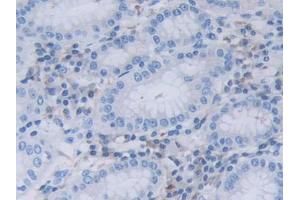 DAB staining on IHC-P; Samples: Human Stomach cancer Tissue (RNASEL 抗体  (AA 358-583))