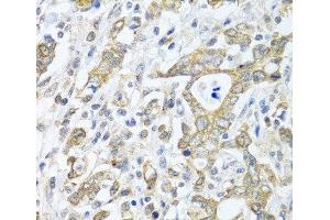 Immunohistochemistry of paraffin-embedded Human gastric cancer using TICAM1 Polyclonal Antibody at dilution of 1:100 (40x lens). (TICAM1 抗体)