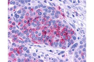 Anti-ADCYAP1R1 / PAC1 Receptor antibody IHC of human Ovary, Carcinoma. (ADCYAP1R1 抗体  (C-Term))
