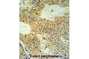 CLDN23 Antibody (C-term) IHC analysis in formalin fixed and paraffin embedded colon carcinoma followed by peroxidase conjugation of the secondary antibody and DAB staining. (Claudin 23 抗体  (C-Term))
