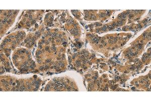 Immunohistochemistry of paraffin-embedded Human breast cancer tissue using CTNNBIP1 Polyclonal Antibody at dilution 1:30 (CTNNBIP1 抗体)