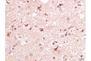 Formalin-fixed and paraffin embedded human brain glioma labeled with Anti-Torc1 (Ser151) Polyclonal Antibody, Unconjugated  at 1:200 followed by conjugation to the secondary antibody and DAB staining. (CRTC1 抗体  (pSer151))