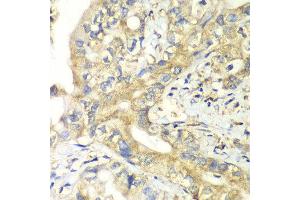 Immunohistochemistry of paraffin-embedded human liver cancer using TIMM17A antibody at dilution of 1:100 (x40 lens). (TIMM17A 抗体)
