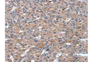 The image on the left is immunohistochemistry of paraffin-embedded Human liver cancer tissue using ABIN7130819(RASAL1 Antibody) at dilution 1/20, on the right is treated with fusion protein. (RASAL1 抗体)