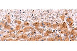 Immunohistochemistry of paraffin-embedded Human liver cancer tissue using NCAN Polyclonal Antibody at dilution of 1:30(x200) (Neurocan 抗体)
