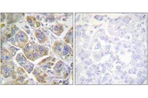 Immunohistochemistry analysis of paraffin-embedded human breast carcinoma tissue, using Integrin beta4 (Ab-1510) Antibody. (Integrin beta 4 抗体  (AA 1481-1530))