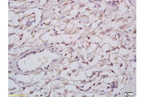 Formalin-fixed and paraffin embedded human cervical carcinoma labeled with Anti-Nogo A+B Polyclonal Antibody, Unconjugated  at 1:200 followed by conjugation to the secondary antibody and DAB staining (Reticulon 4 抗体  (AA 251-357))