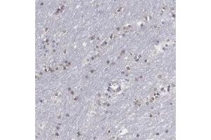 Immunohistochemical staining (Formalin-fixed paraffin-embedded sections) of human lateral ventricle with SOX11 polyclonal antibody  shows nuclear positivity in glial cells at 1:200 - 1:500 dilution.