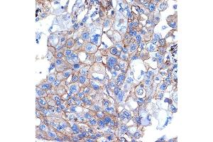 Immunohistochemistry of paraffin-embedded human lung cancer using Talin 2 Rabbit mAb (ABIN7270720) at dilution of 1:100 (40x lens). (TLN2 抗体)