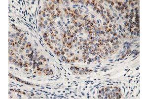 Immunohistochemical staining of paraffin-embedded Carcinoma of Human pancreas tissue using anti-HOXC11 mouse monoclonal antibody. (HOXC11 抗体)