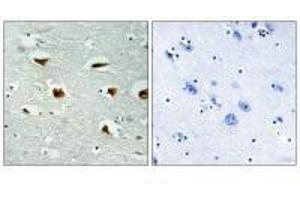 Immunohistochemical analysis of paraffin-embedded human colon carcinoma tissue using 4E-BP1 (Ab-69) antibody. (eIF4EBP1 抗体  (Thr70))