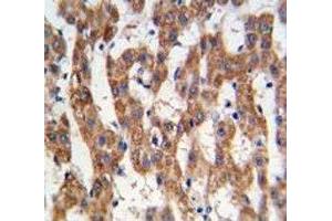 IHC analysis of FFPE human hepatocarcinoma tissue stained with PHB antibody (Prohibitin 抗体  (AA 89-117))